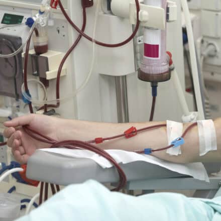 Damar Yolu Türleri: A-V Fistül ve A-V Greft Nedir? damar yolu türleri
